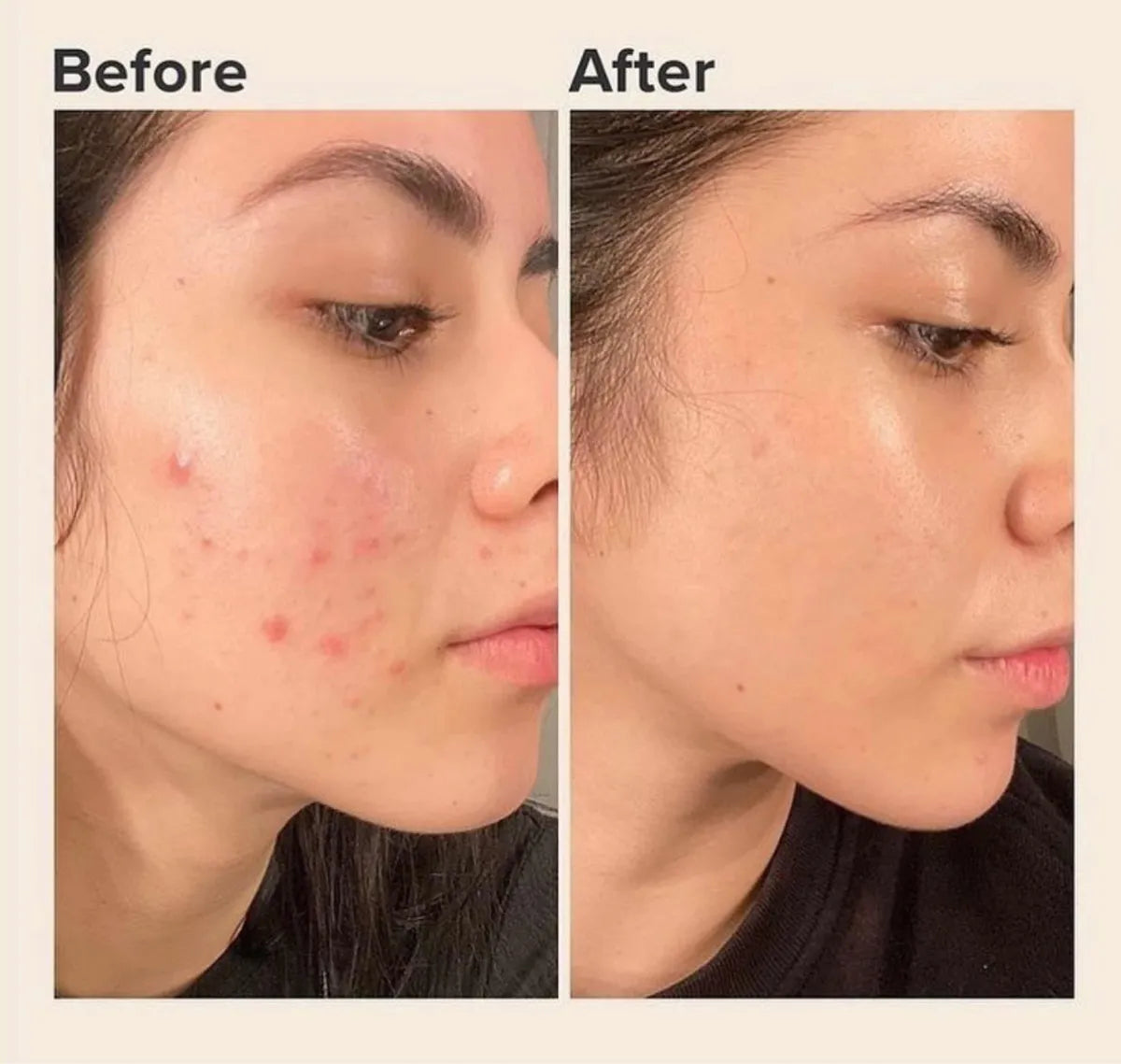 Acido Salicilico The Ordinary